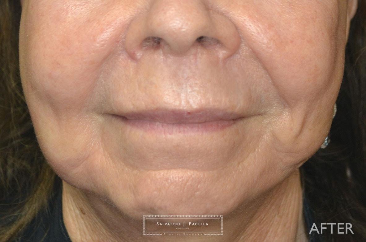 Salvatore J Pacella, MD Cosmetic & Plastic Surgery lip lift after — San Diego, CA