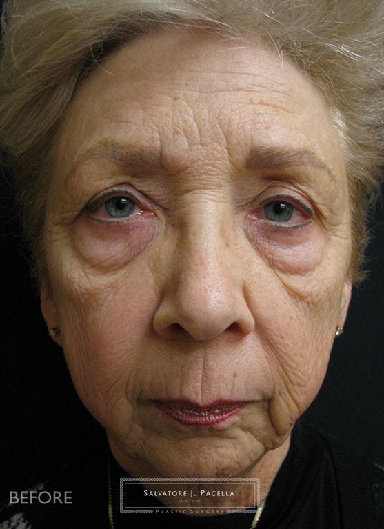 Facelift before at Salvatore J Pacella, MD Cosmetic & Plastic Surgery in San Diego, CA