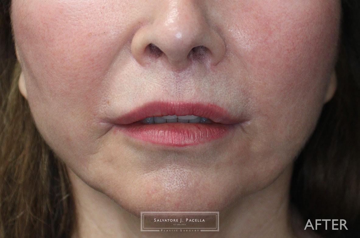 Salvatore J Pacella, MD Cosmetic & Plastic Surgery lip lift after — San Diego, CA