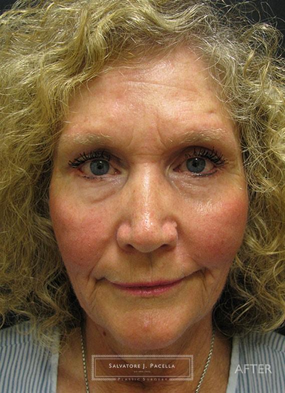 Salvatore J Pacella, MD Cosmetic & Plastic Surgery blepharoplasty after — San Diego, CA
