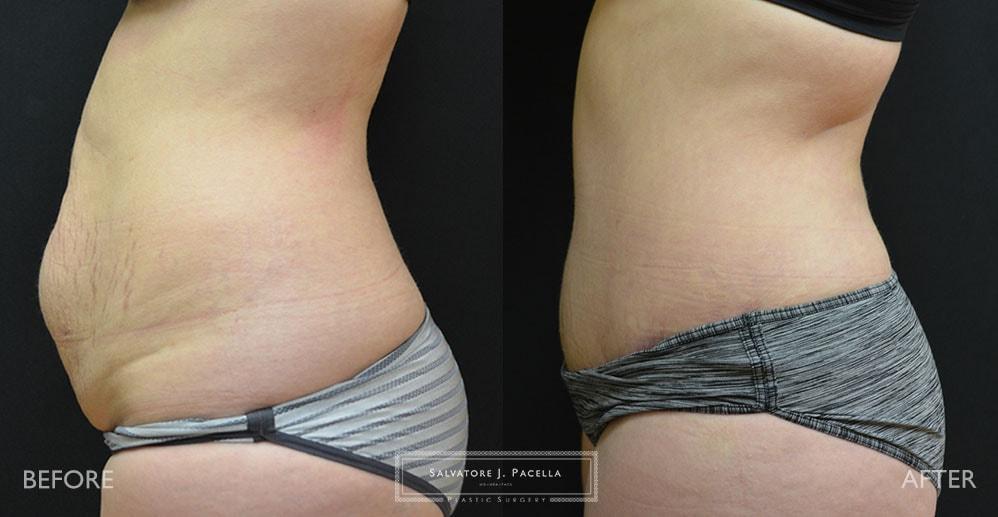 Salvatore J Pacella, MD Cosmetic & Plastic Surgery tummy tuck result — San Diego, CA