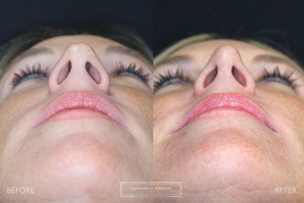 Salvatore J Pacella, MD Cosmetic & Plastic Surgery rhinoplasty result — San Diego, CA
