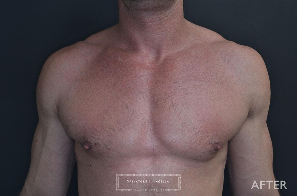 Salvatore J Pacella, MD Cosmetic & Plastic Surgery gynecomastia after — San Diego, CA
