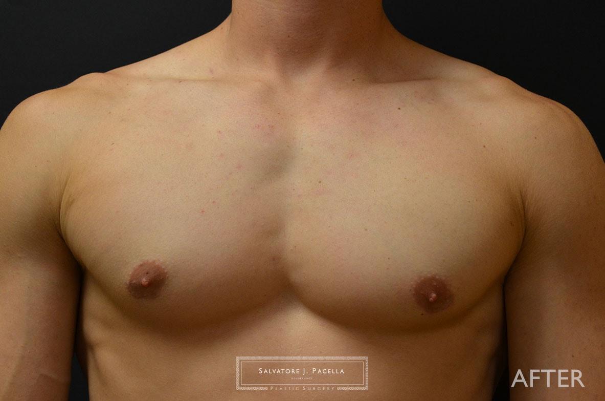 Salvatore J Pacella, MD Cosmetic & Plastic Surgery gynecomastia after — San Diego, CA