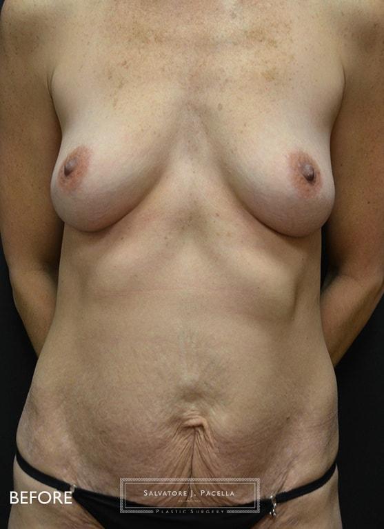 Mommy Makeover before at Salvatore J Pacella, MD Cosmetic & Plastic Surgery in San Diego, CA