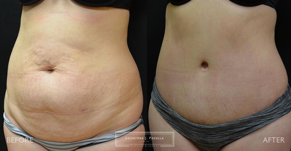 Salvatore J Pacella, MD Cosmetic & Plastic Surgery tummy tuck result — San Diego, CA