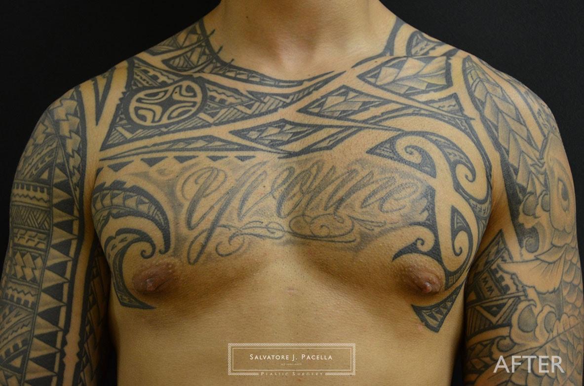 Salvatore J Pacella, MD Cosmetic & Plastic Surgery gynecomastia after — San Diego, CA