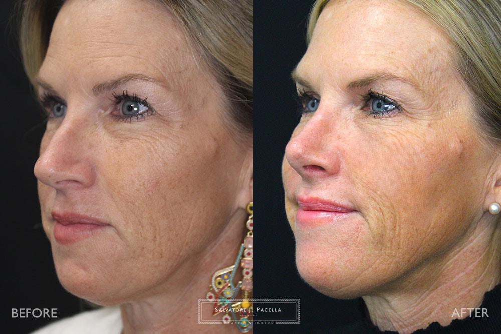 Salvatore J Pacella, MD Cosmetic & Plastic Surgery rhinoplasty result — San Diego, CA