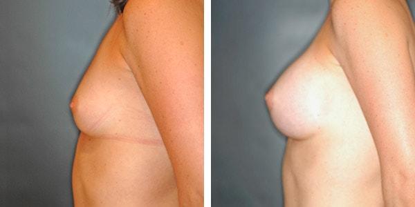 Handler Barry S MD: Cosmetic & Reconstructive Surgery breast augmentation result — San Diego, CA