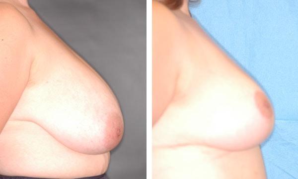 Breast Reduction result at Handler Barry S MD: Cosmetic & Reconstructive Surgery in San Diego, CA