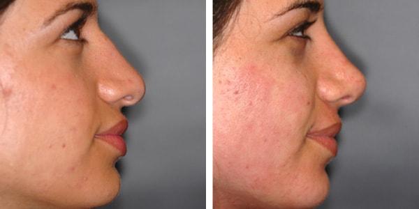 Functional Rhinoplasty result at Handler Barry S MD: Cosmetic & Reconstructive Surgery in San Diego, CA