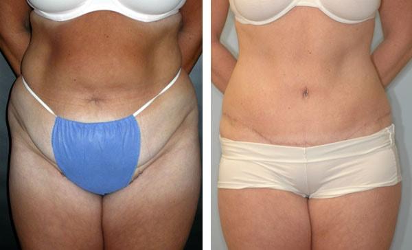 Mini Tummy Tuck result at Handler Barry S MD: Cosmetic & Reconstructive Surgery in San Diego, CA
