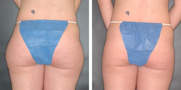 Liposuction result at Handler Barry S MD: Cosmetic & Reconstructive Surgery in San Diego, CA