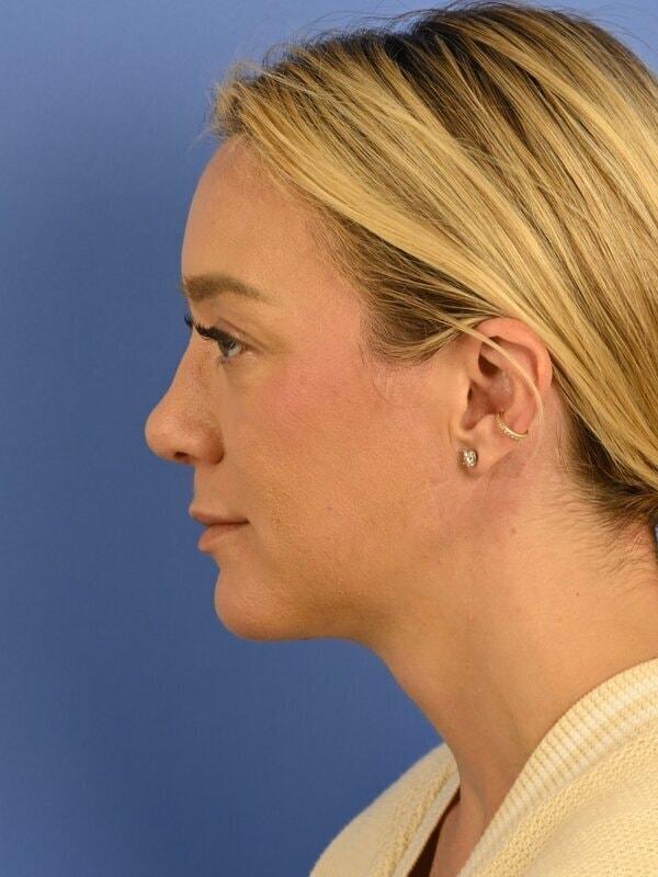 Face Forward Houston (Regina Rodman, MD) neck lift after — Houston, TX