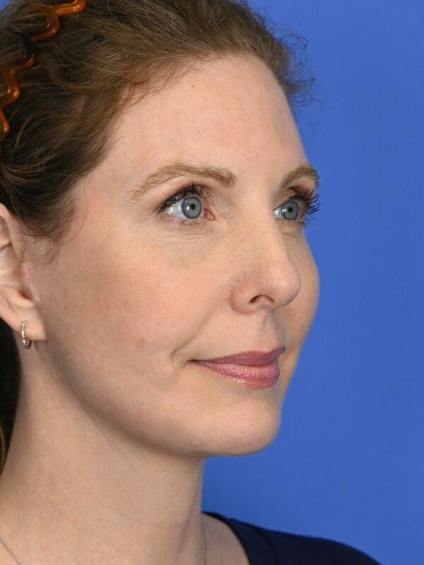 Face Forward Houston (Regina Rodman, MD) neck lift after — Houston, TX