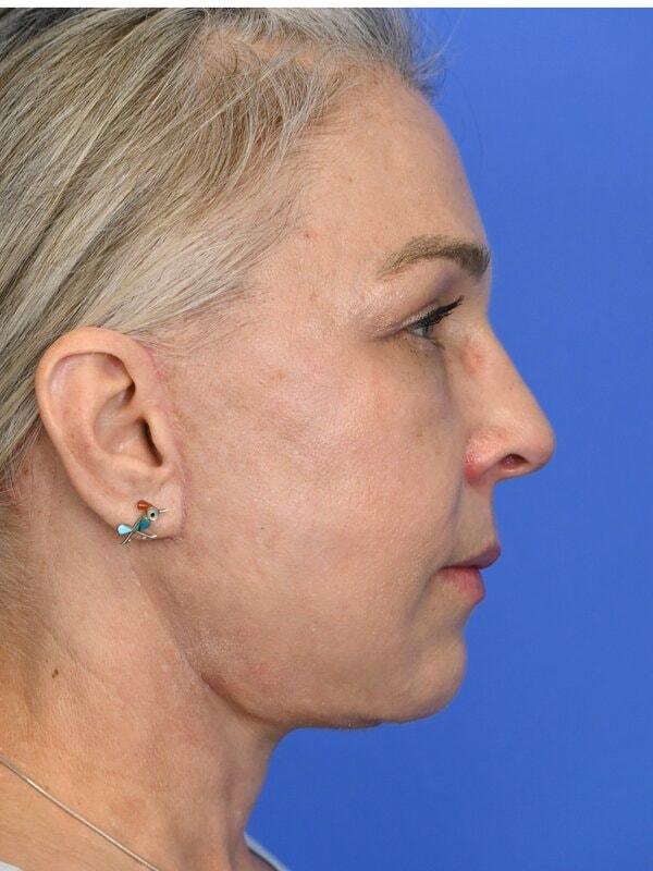 Face Forward Houston (Regina Rodman, MD) neck lift after — Houston, TX