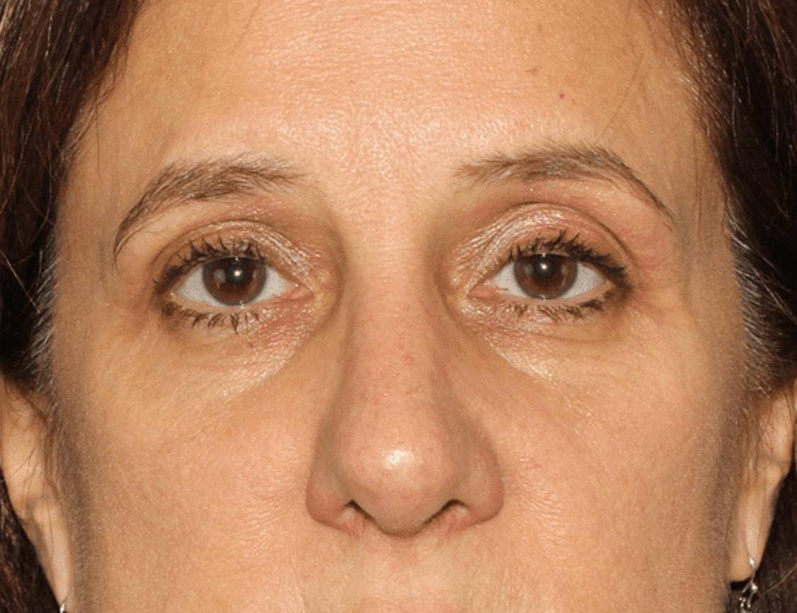Face Forward Houston (Regina Rodman, MD) rhinoplasty after — Houston, TX