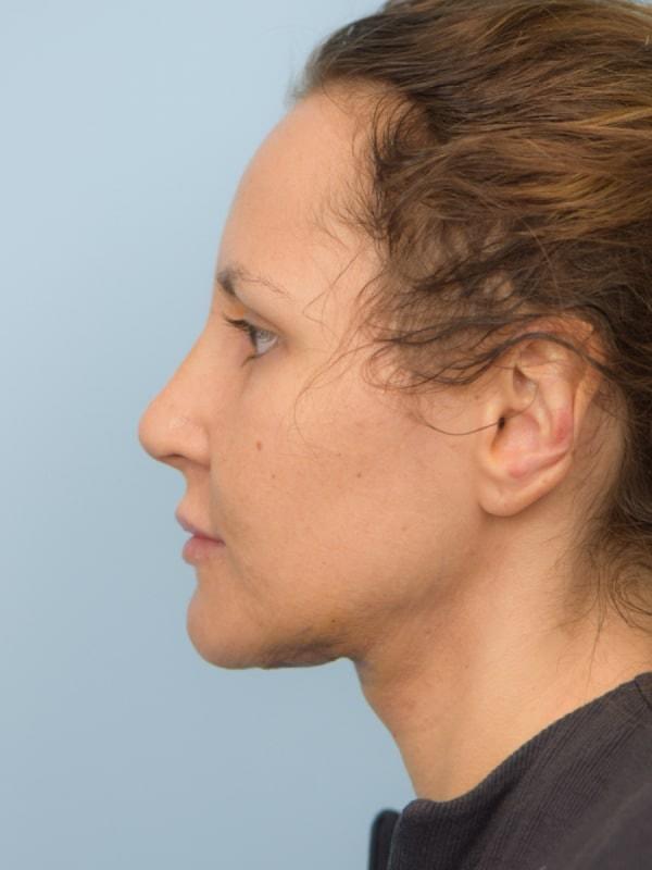 Face Forward Houston (Regina Rodman, MD) rhinoplasty after — Houston, TX