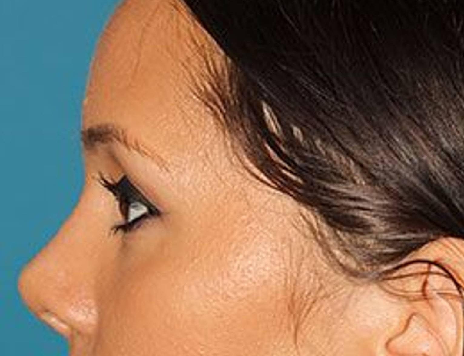 Face Forward Houston (Regina Rodman, MD) rhinoplasty after — Houston, TX