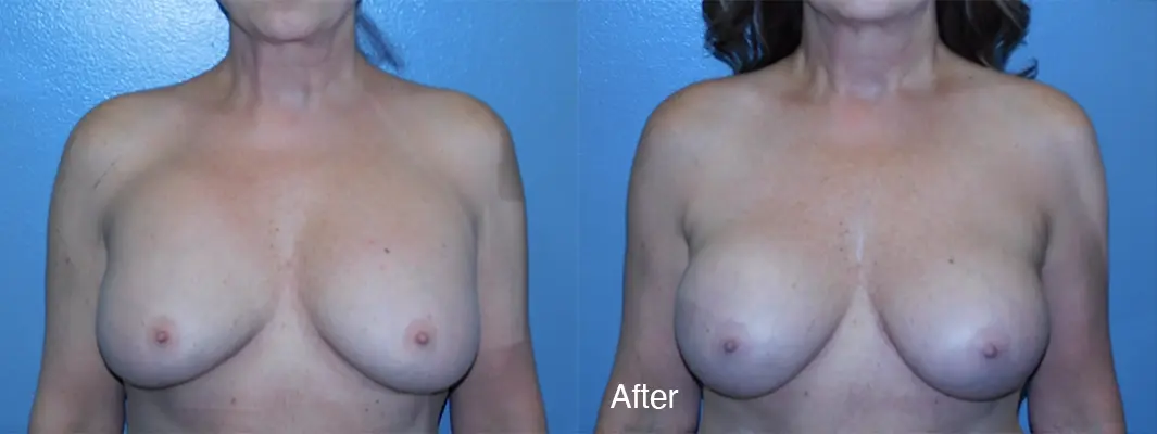 Michell Cohn, DO - Cosmetic Surgical Arts and Rejuvenation Of Oklahoma result — Oklahoma City, OK