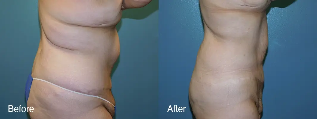Michell Cohn, DO - Cosmetic Surgical Arts and Rejuvenation Of Oklahoma liposuction result — Oklahoma City, OK
