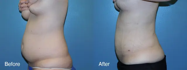 Liposuction result at Michell Cohn, DO - Cosmetic Surgical Arts and Rejuvenation Of Oklahoma in Oklahoma City, OK