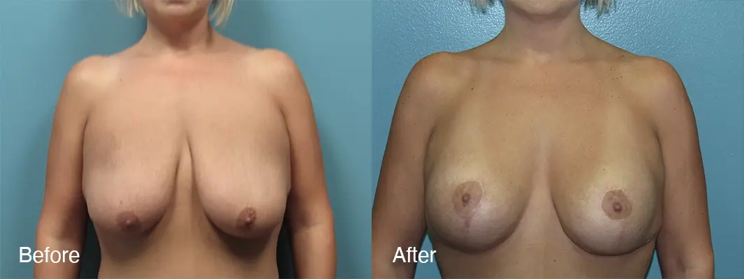 Michell Cohn, DO - Cosmetic Surgical Arts and Rejuvenation Of Oklahoma breast augmentation result — Oklahoma City, OK