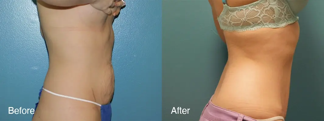 Michell Cohn, DO - Cosmetic Surgical Arts and Rejuvenation Of Oklahoma tummy tuck result — Oklahoma City, OK