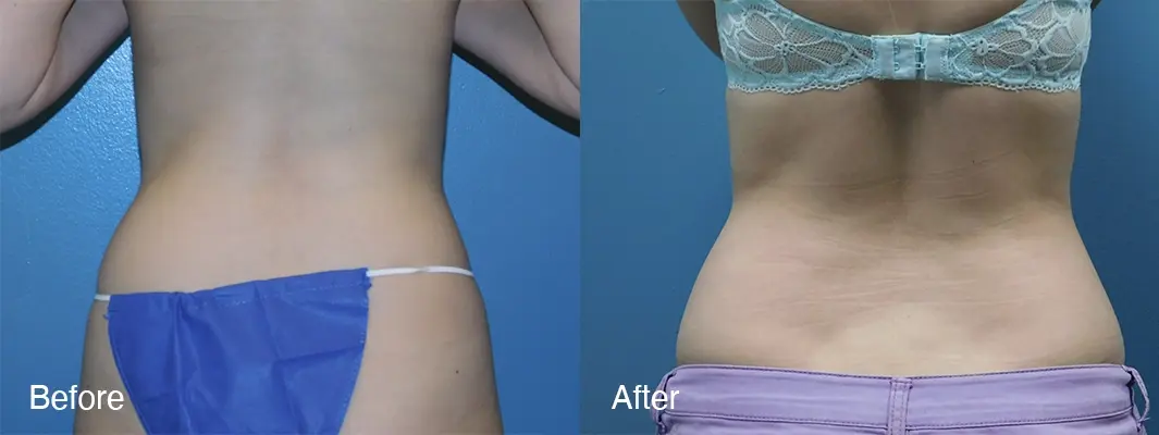 Michell Cohn, DO - Cosmetic Surgical Arts and Rejuvenation Of Oklahoma tummy tuck result — Oklahoma City, OK