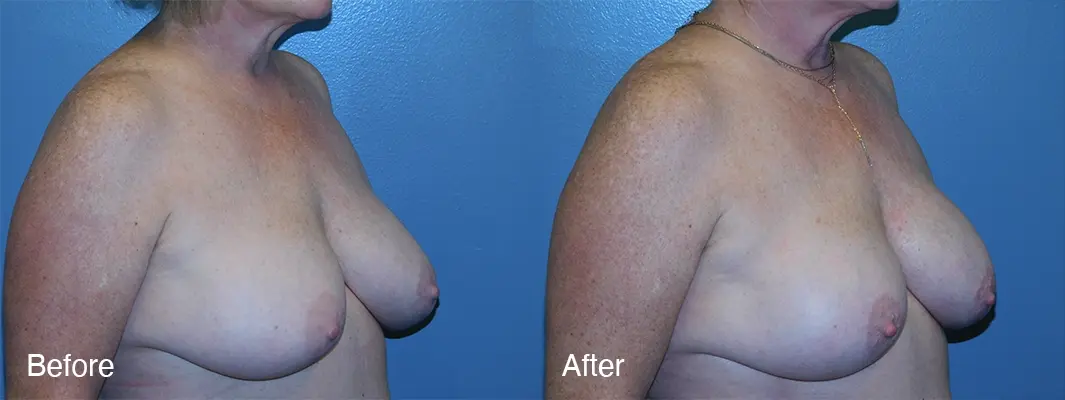 Michell Cohn, DO - Cosmetic Surgical Arts and Rejuvenation Of Oklahoma breast augmentation result — Oklahoma City, OK