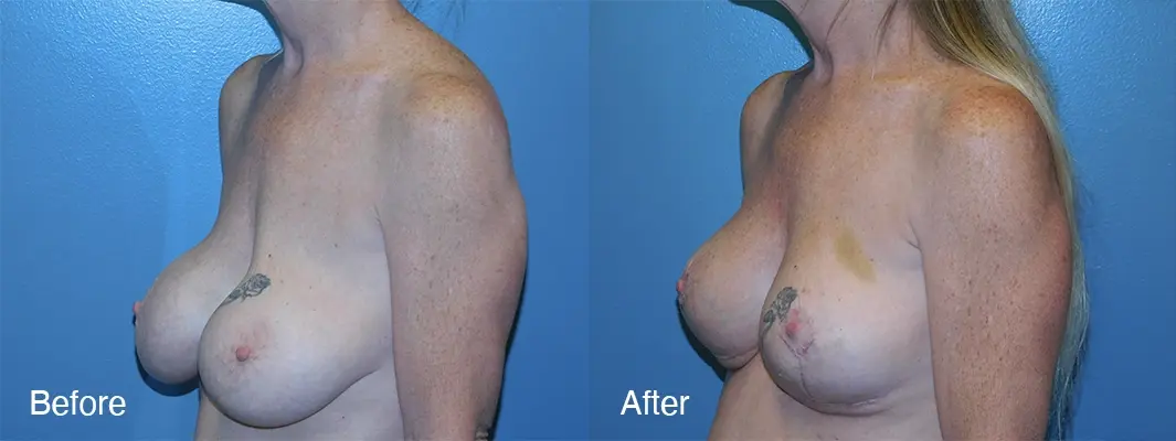 Michell Cohn, DO - Cosmetic Surgical Arts and Rejuvenation Of Oklahoma result — Oklahoma City, OK