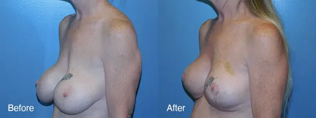 Breast Lift result at Michell Cohn, DO - Cosmetic Surgical Arts and Rejuvenation Of Oklahoma in Oklahoma City, OK