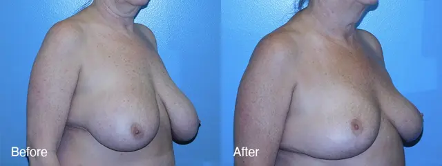 Breast Lift result at Michell Cohn, DO - Cosmetic Surgical Arts and Rejuvenation Of Oklahoma in Oklahoma City, OK