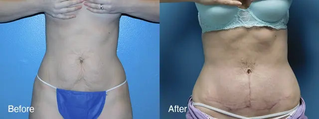 Mommy Makeover result at Michell Cohn, DO - Cosmetic Surgical Arts and Rejuvenation Of Oklahoma in Oklahoma City, OK