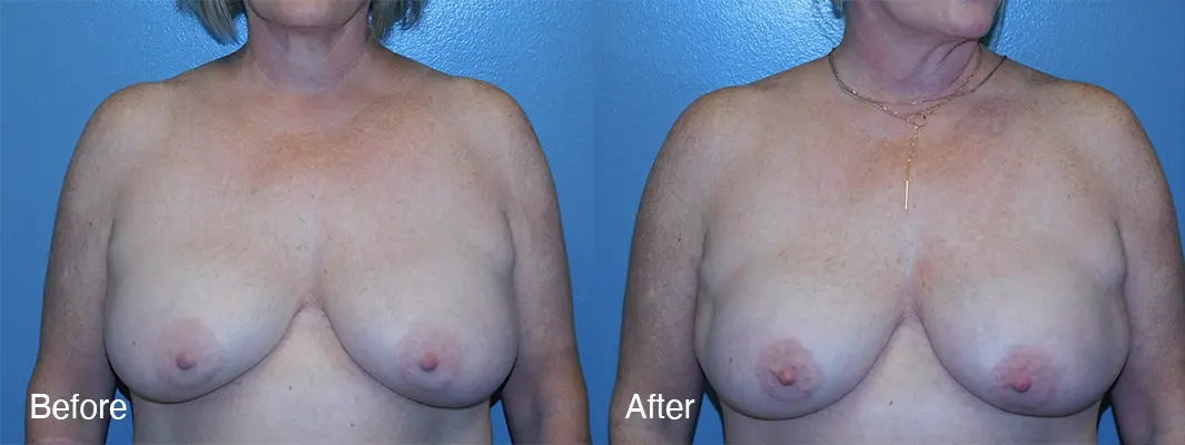 Michell Cohn, DO - Cosmetic Surgical Arts and Rejuvenation Of Oklahoma breast augmentation result — Oklahoma City, OK