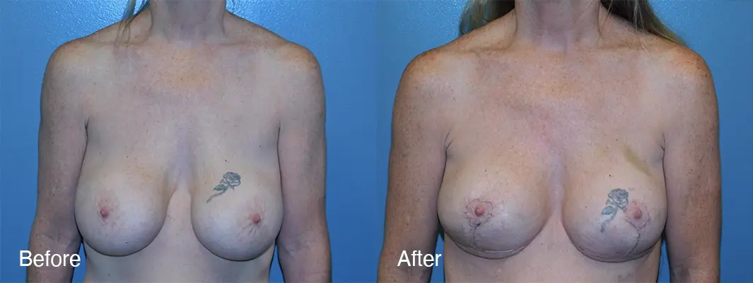 Michell Cohn, DO - Cosmetic Surgical Arts and Rejuvenation Of Oklahoma result — Oklahoma City, OK
