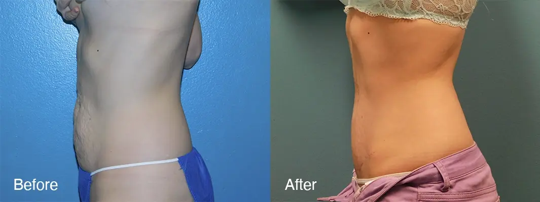 Michell Cohn, DO - Cosmetic Surgical Arts and Rejuvenation Of Oklahoma tummy tuck result — Oklahoma City, OK