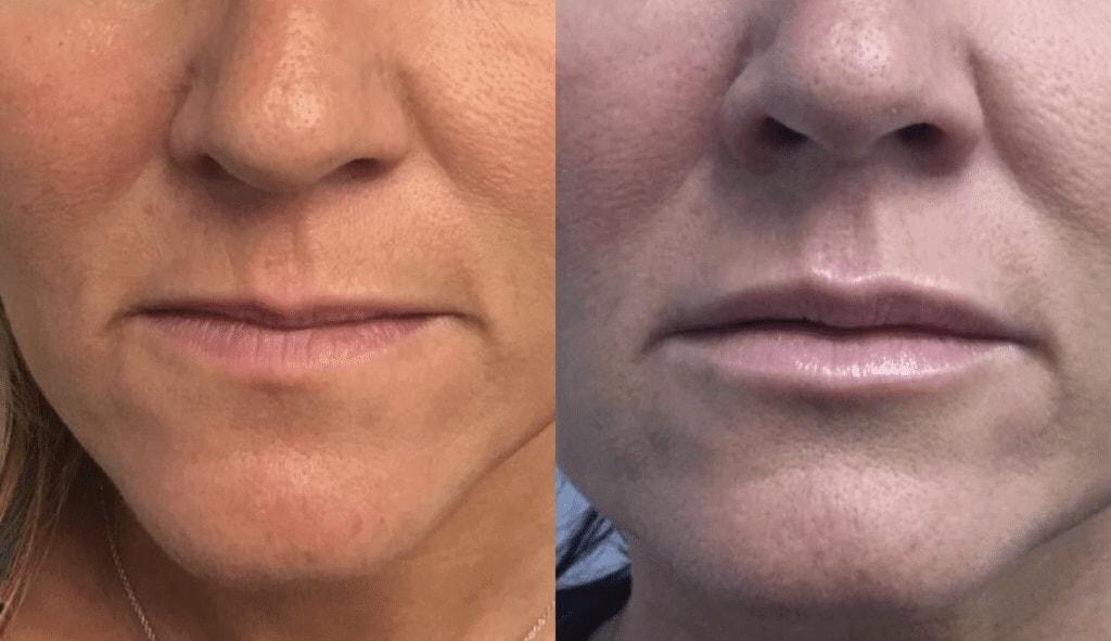 Schlessinger Eye & Face lip filler result — Woodbury, NY