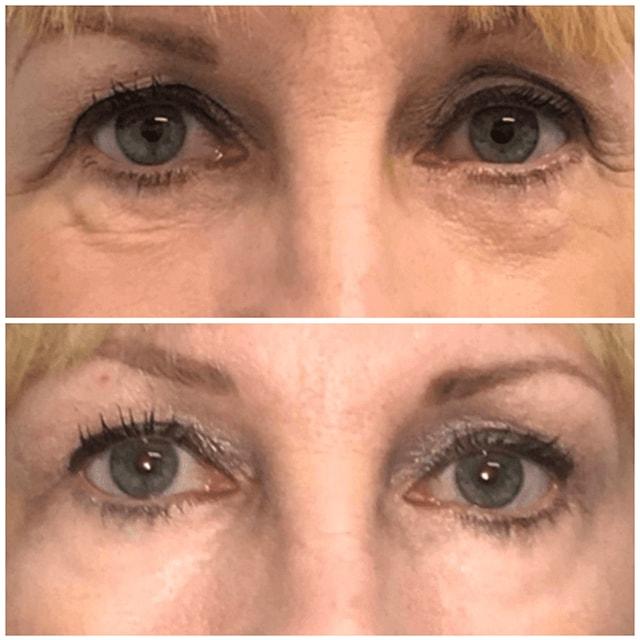 Schlessinger Eye & Face under-eye filler result — Woodbury, NY