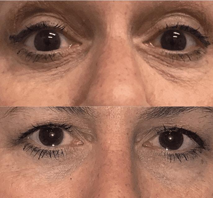 Schlessinger Eye & Face under-eye filler result — Woodbury, NY