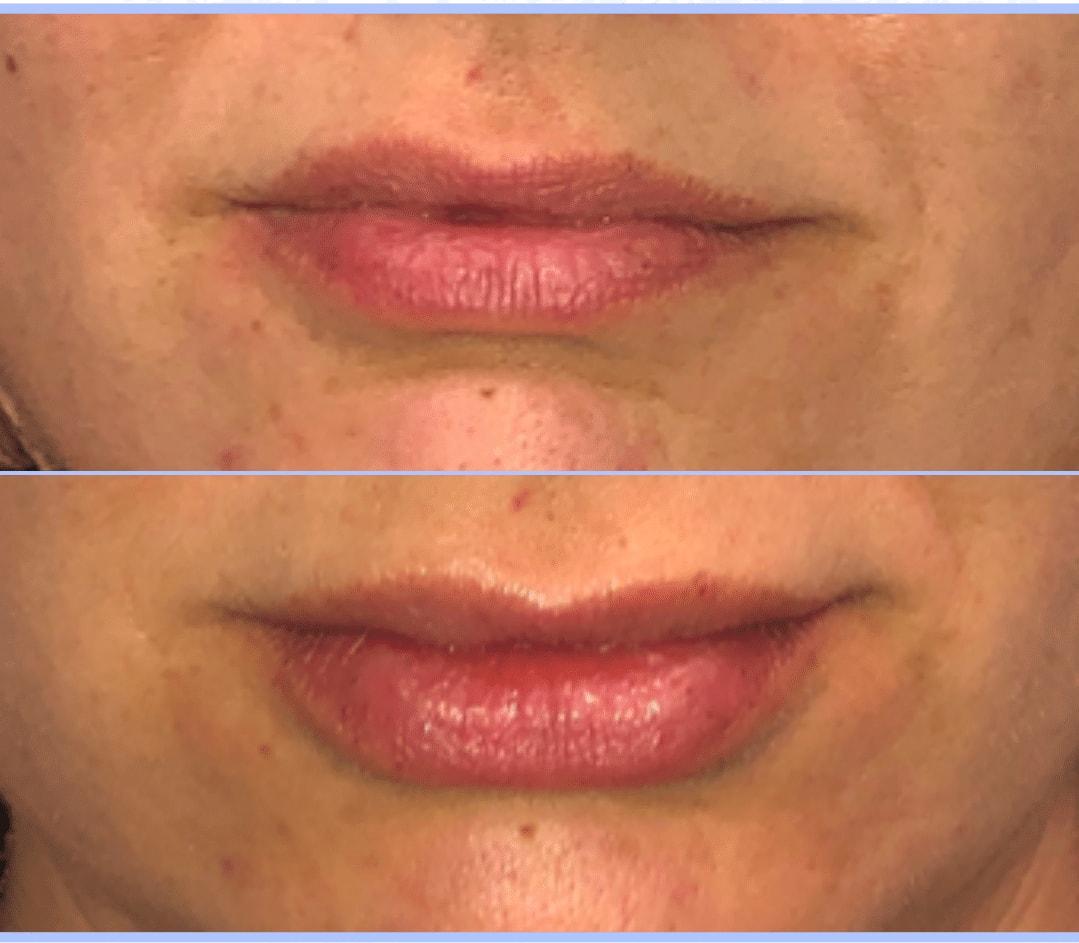 Schlessinger Eye & Face lip filler result — Woodbury, NY