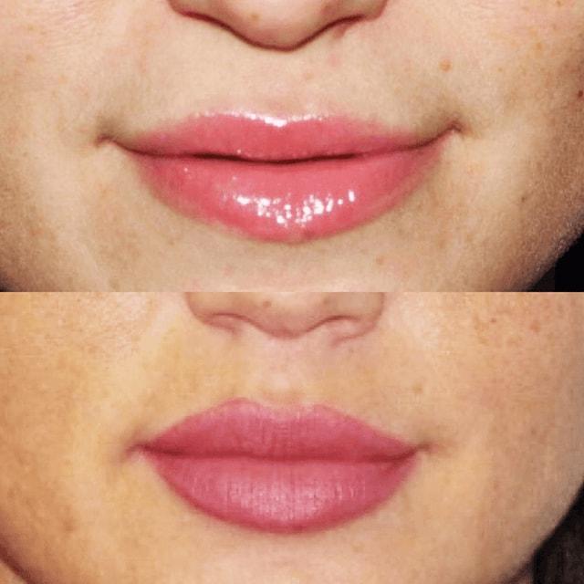 Schlessinger Eye & Face lip filler result — Woodbury, NY