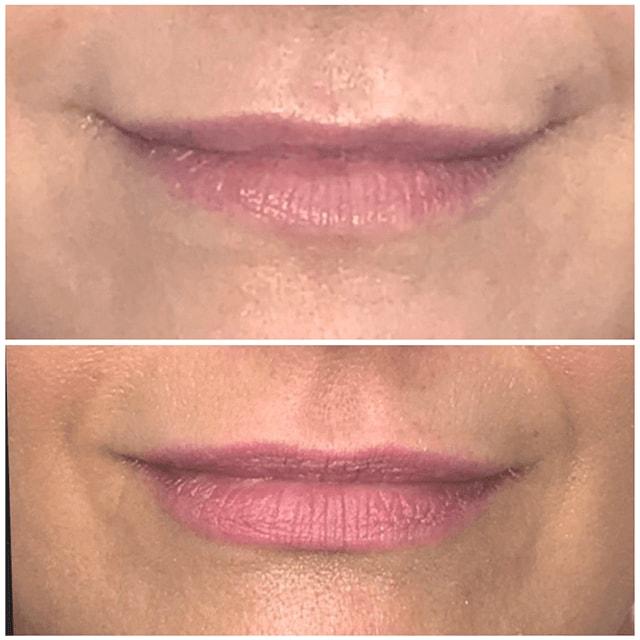 Schlessinger Eye & Face lip filler result — Woodbury, NY