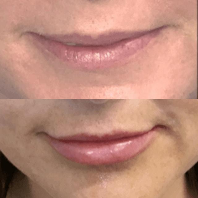 Schlessinger Eye & Face lip filler result — Woodbury, NY