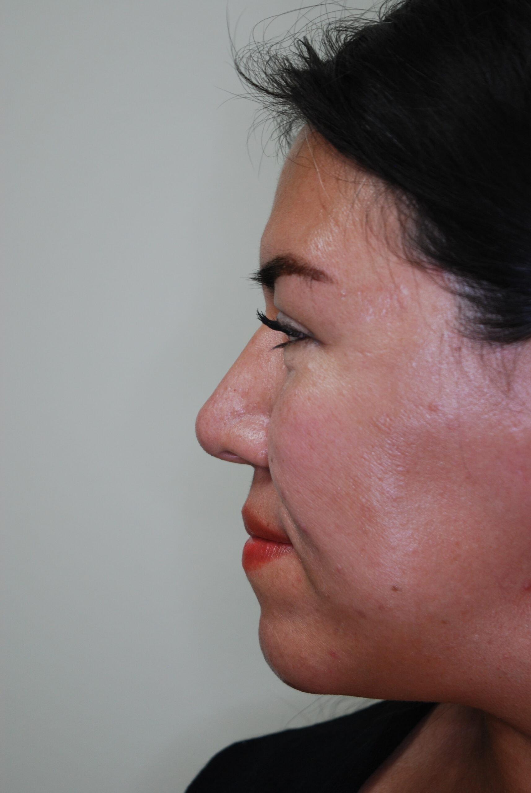 John R. Bennett, MD rhinoplasty after — Draper, UT