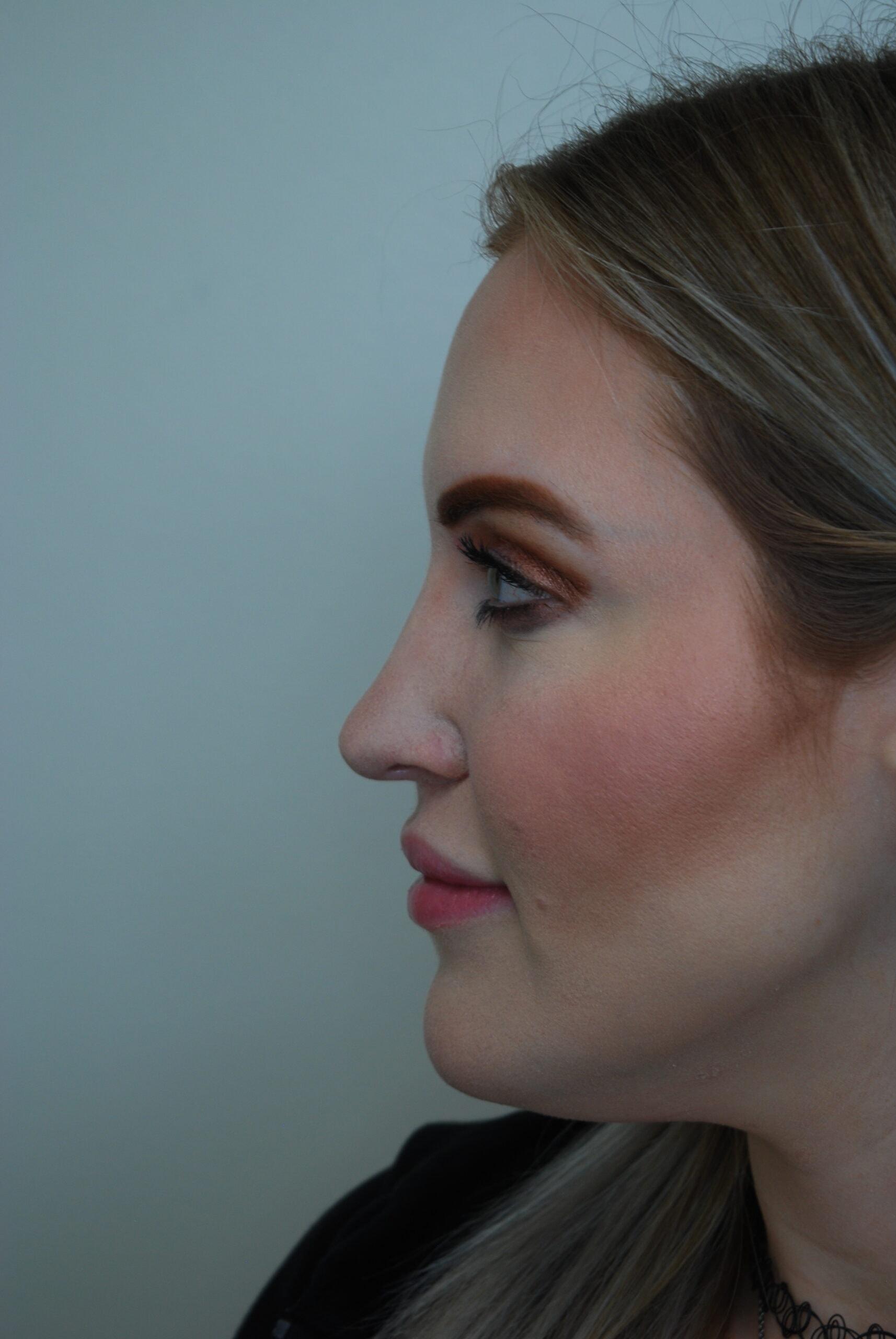 John R. Bennett, MD rhinoplasty after — Draper, UT