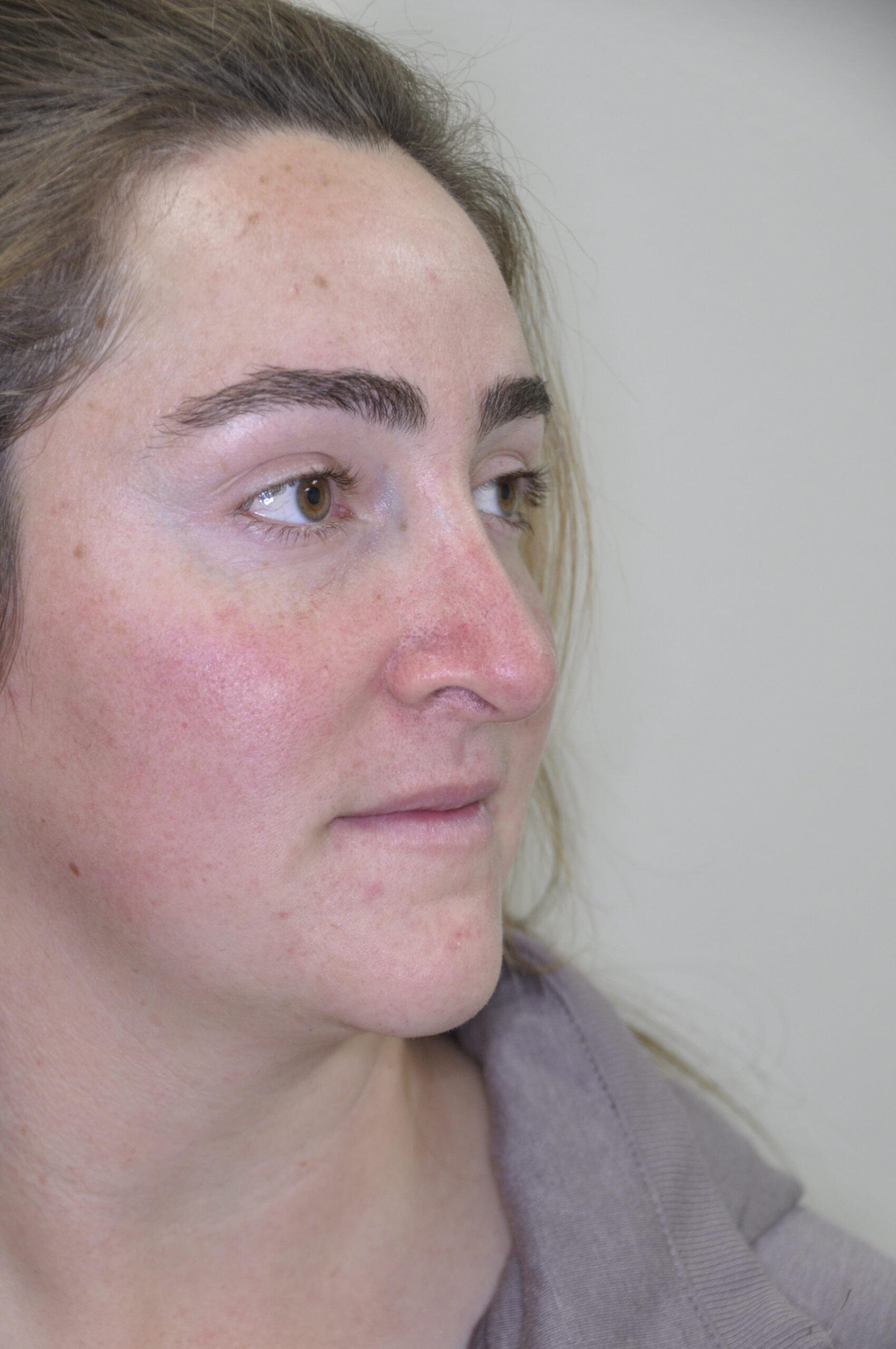 John R. Bennett, MD rhinoplasty after — Draper, UT