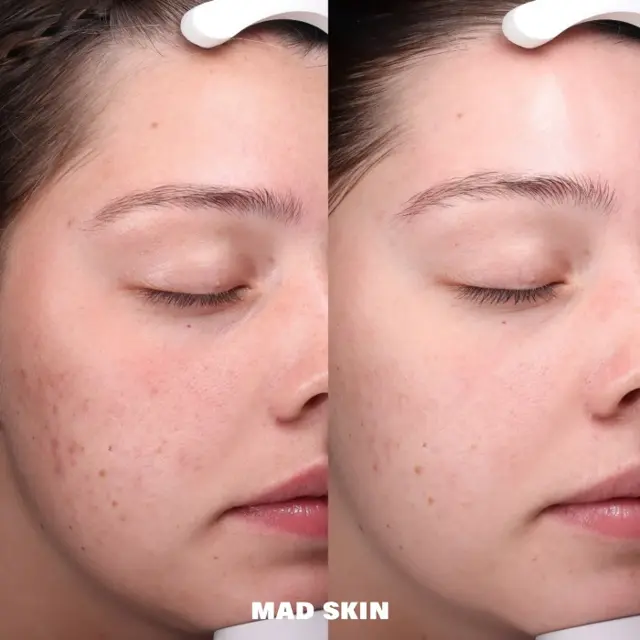 Microneedling result at MAD SKIN in Lehi, UT