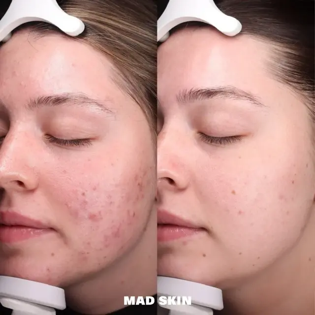 Chemical Peel result at MAD SKIN in Lehi, UT