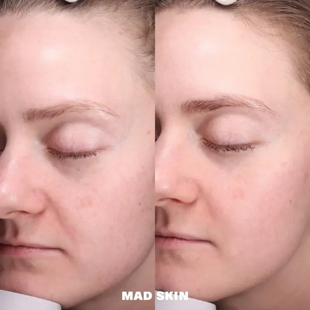 Morpheus8 result at MAD SKIN in Lehi, UT
